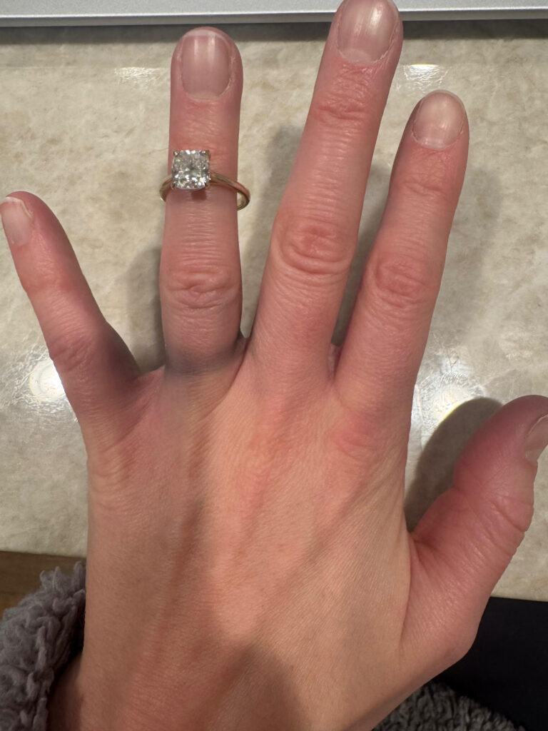 A shot of a hand with discoloration where wedding bands were previously